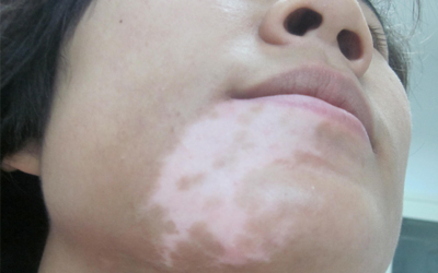 治疗白癜风用美国308nm准分子激光治疗系统