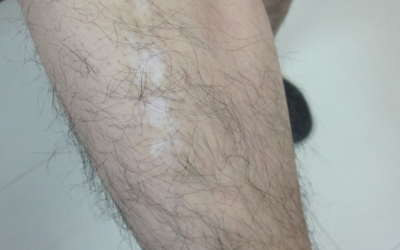 308准分子激光治白癜风