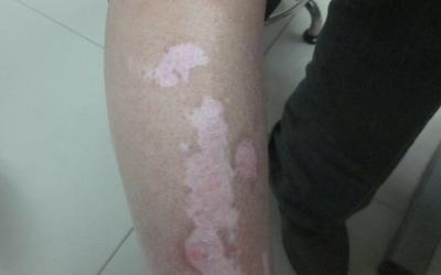 308激光准分子治疗白斑