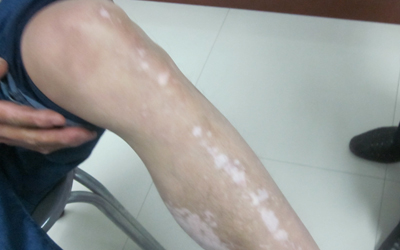 白癜风左腿至阴部多处用308无效果吗