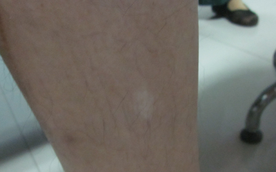 308激光治疗白驳风能不能完整治好