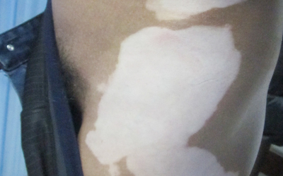 308治疗白癜风机器几钱一台