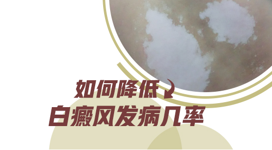 308激光治疗初期白癜风几天能治好