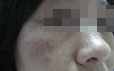 308激光白癜风怎样治疗效果好呢