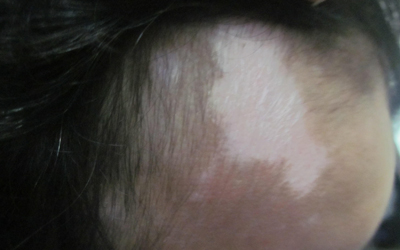 白癜风多照几次308是不是好的快