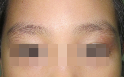 308准分子激光治疗价钱贵