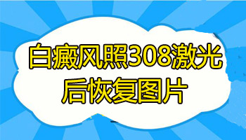 白癜风激光后都要冰敷吗