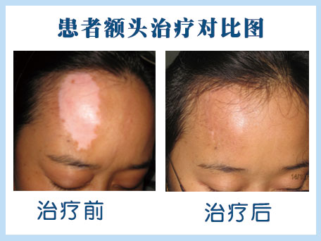 什么样的人容易得白癜风