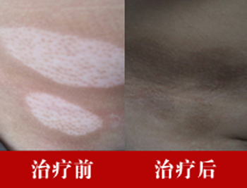白癜风到底是由什么原因引发的