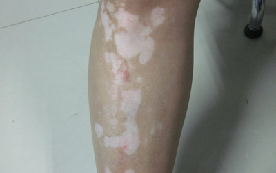 腿上出现小白斑是什么原因造成的