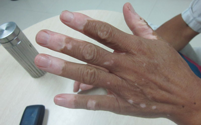 手指末端皮肤变白是什么原因