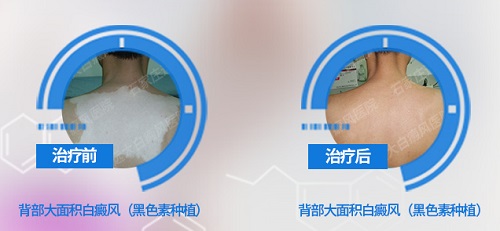 白癜风长在后背上怎么治疗