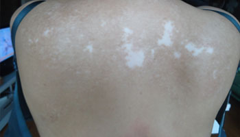 背部局部皮肤是白色的怎么回事
