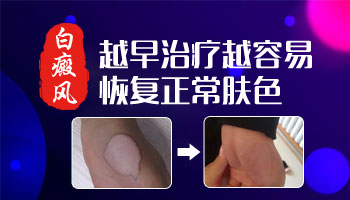 脖子上长小白斑治疗用什么方法好