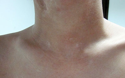脖子上的白斑发现有一个月了比以前大了