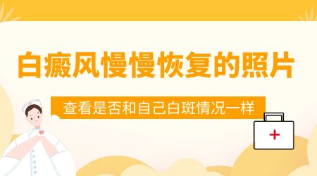 脖子上白癜风好多年了怎么能治好