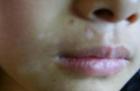 嘴唇上白癜风的早期症状都有哪些