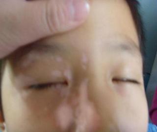 白癜风发展到了眼皮上应该如何治疗