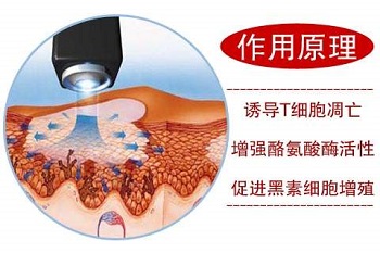 脸颊长白癜风做308激光能不能好