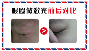 治疗眉毛白癜风哪一款光疗仪好