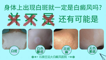 脸上淡白色的斑点是不是白癜风