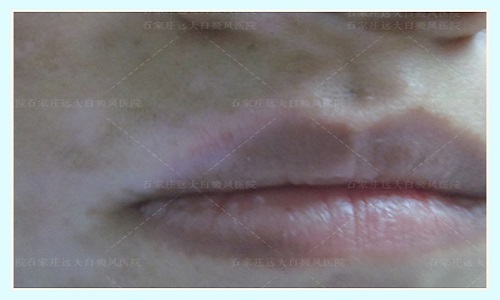 嘴唇白斑的早期图片