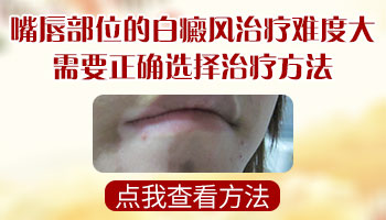 白癜风长嘴唇黏膜上怎么治