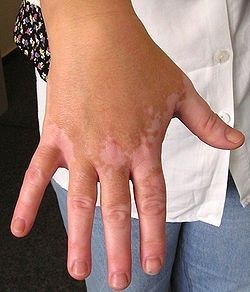 手指白癜风人群的症状