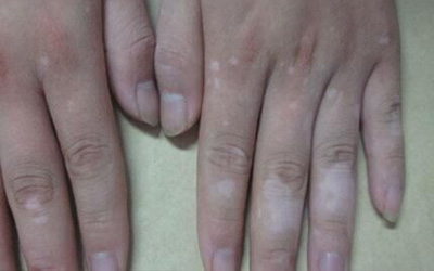 手指关节处发白是什么原因