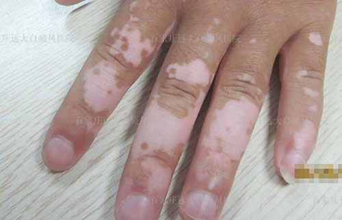 十个手指头关节处皮肤都是白色怎么回事