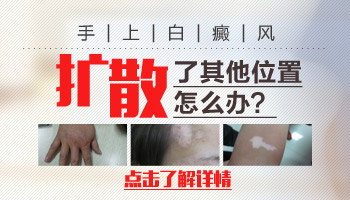 手指上的白癜风扩散了怎么治疗好