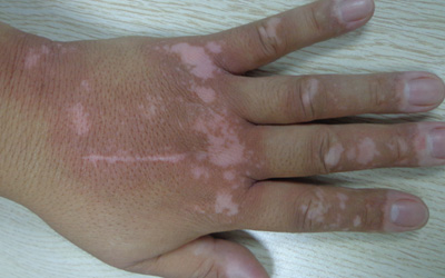 手背白斑早期症状图片