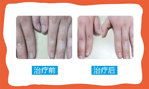 手指点状白斑是怎么回事