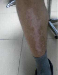 小腿上有些白点点是白癜风的症状吗