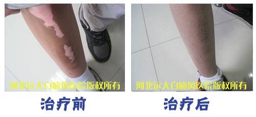 小孩腿上长白斑是什么病