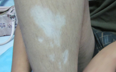 腿上出现了很多白色的小斑块是什么