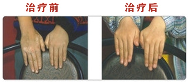 十一黄金周结束 您的白斑治好了吗