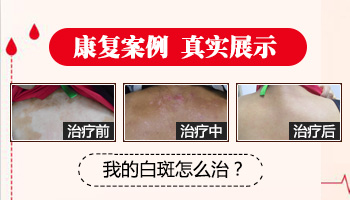 白癜风的好转期有什么征兆