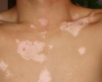 白癜风患者治疗需要住院吗