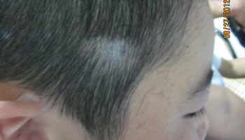 白癜风患者染头发对病情有影响吗
