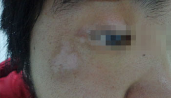 女性的白癜风早期是怎么发病的