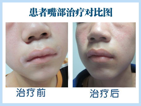 白癜风患者做培植手术的效果图