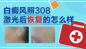 308激光照白癜风恢复变化图