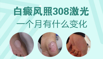 美国308激光能把白斑照没吗