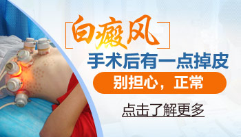 白癜风植皮正常应该多长时间掉皮