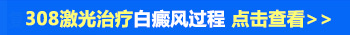 激光治疗白癜风会变的更白吗