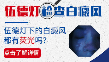 伍德灯弱阳性说明什么 白斑是白癜风吗