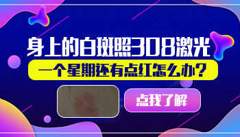 白癜风不泡药浴直接照308可以吗