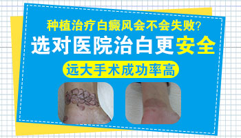 石家庄远大白癜风医院可以做色素种植手术吗