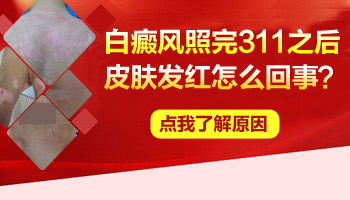 白癜风311照光后发红发痒是怎么回事